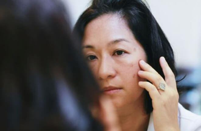 điều trị nám da